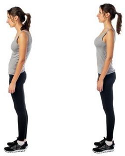 38755494 - woman with impaired posture position defect scoliosis and ideal bearing.